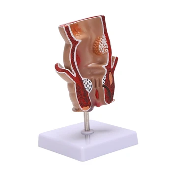 Анатомия Модел на човешка ректална хемороидна лезия Модел на хемороидна фистула фистула Фисура Модел на преподаване на патология